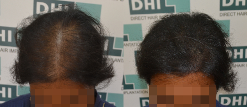 DHI before & after hair transplant results