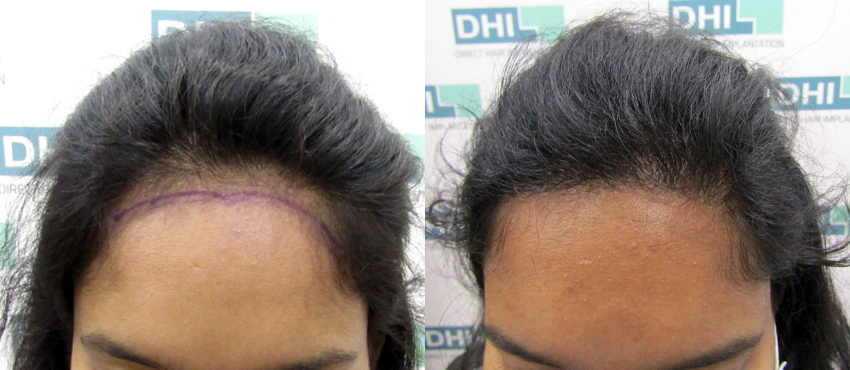 DHI before & after hair transplant results