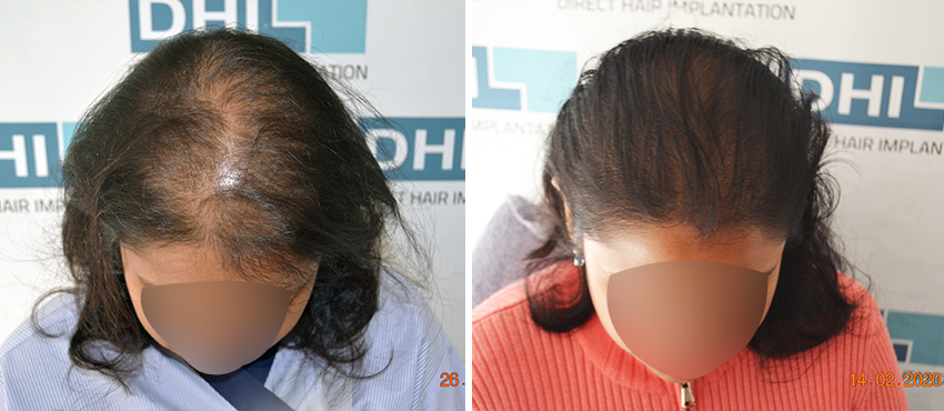 Hair Transplant for Women - Female Hair Transplant in India | DHI India
