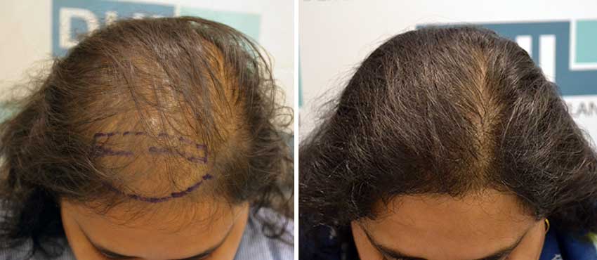 DHI before & after hair transplant results