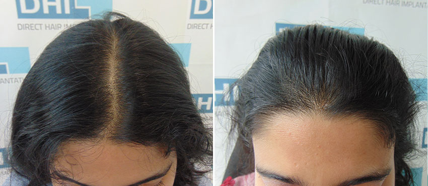 DHI before & after hair transplant results