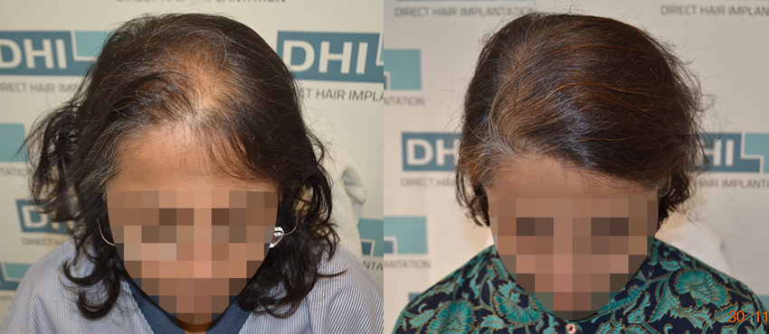 DHI before & after hair transplant results