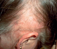 Scarring-Alopecia