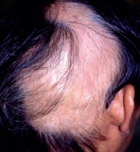 Traction-alopecia