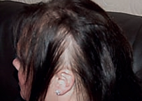 alopecia-areata