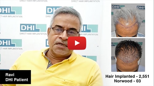 Male Hair Transplant Testimonial