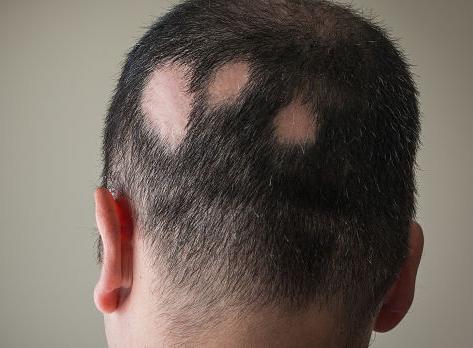 Alopecia Areata