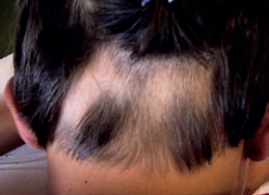 alopecia-areata