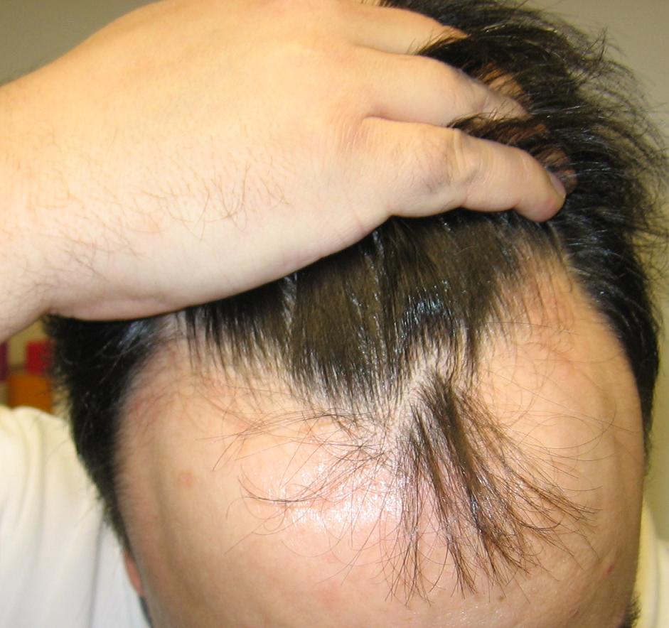 Androgenetic Alopecia male
