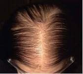 Androgenetic Alopecia Female