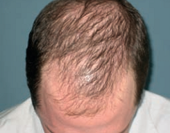 Types-of-Alopecia