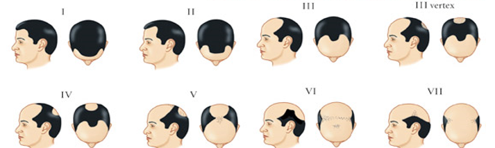 Norwood scale