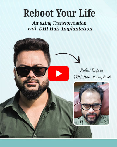 Hair Transplant Result of a Young Business Owner - Hair Transplant in Delhi