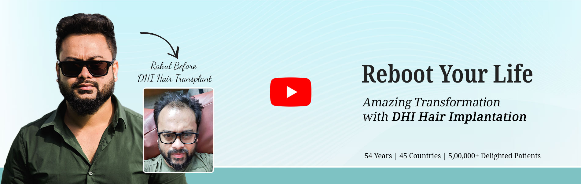 Hair Transplant Result of a Young Business Owner - Hair Transplant in Delhi