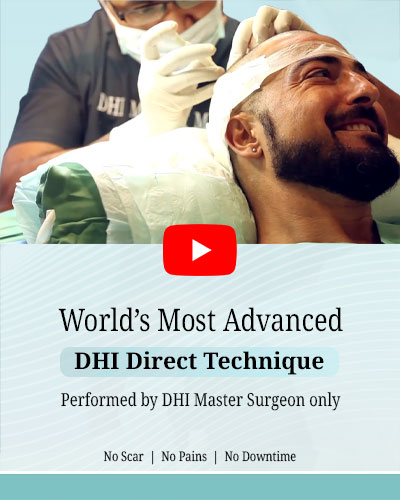 Hair Transplant Result of a Young Business Owner - Hair Transplant in Delhi