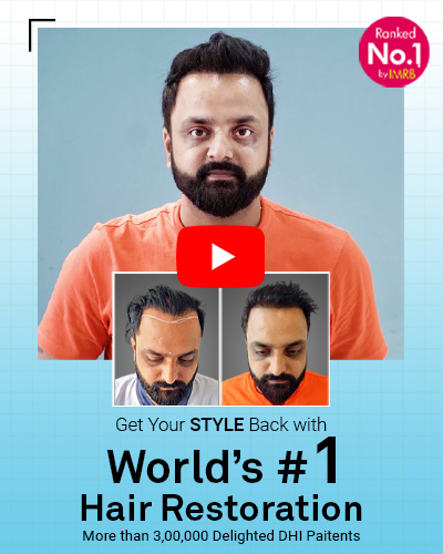 Hair Transplant Result of a Young Business Owner - Hair Transplant in Delhi