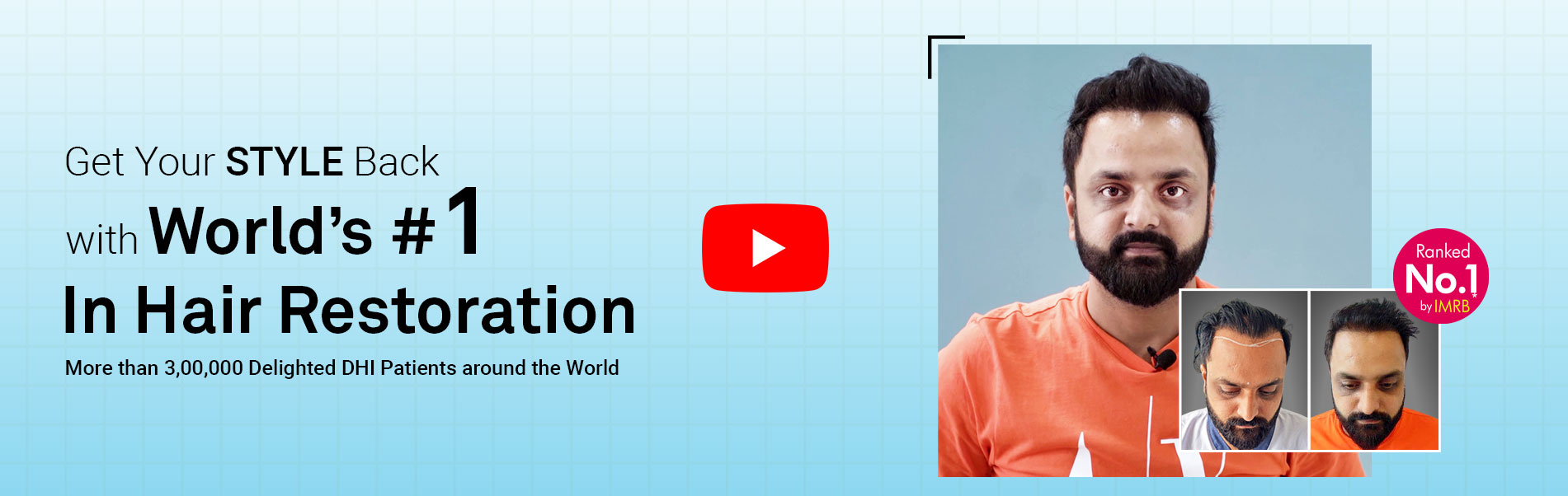 Hair Transplant Result of a Young Business Owner - Hair Transplant in Delhi