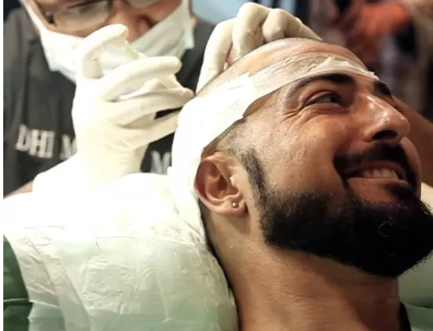 hair transplant treatment in Bangalore