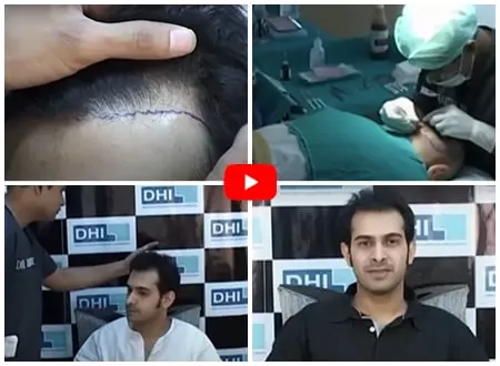 Best Hair Transplant in Bangalore - Hair Transplant Cost in Bangalore -  DHI™ India