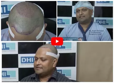 Best Hair Transplant in Bangalore - Hair Transplant Cost in Bangalore -  DHI™ India