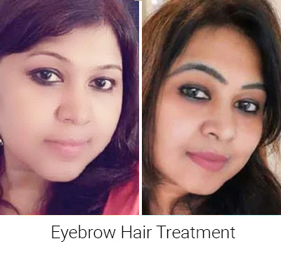 Eyebrow Hair Restoration Transplant Hyderabad Hair Sure