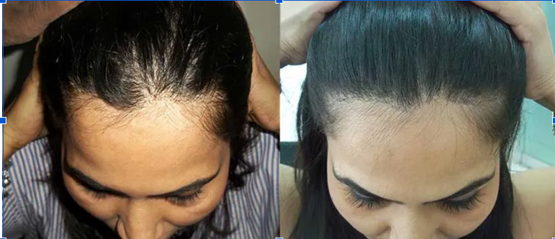Female Pattern Hair Loss (FPHL) before and after