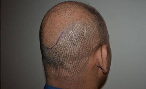 Donor area after FUE surgery                                 