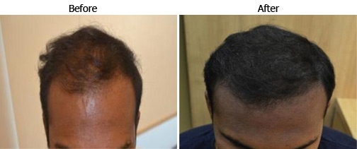 hairloss