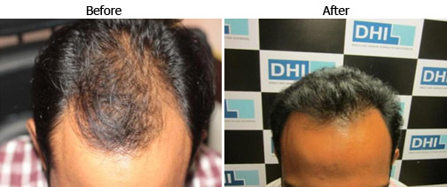 hairloss