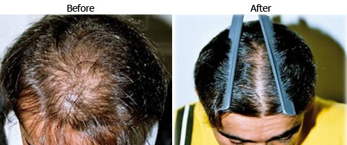 Stop Hair Thinning Now  Get The Best Hair thinning Treatment in Chennai   Aura Clinic