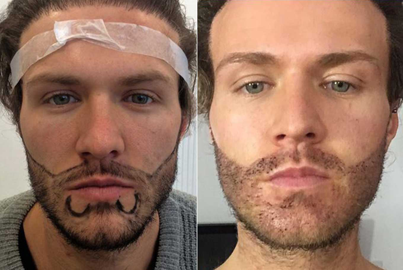 beard transplant Client
                                     