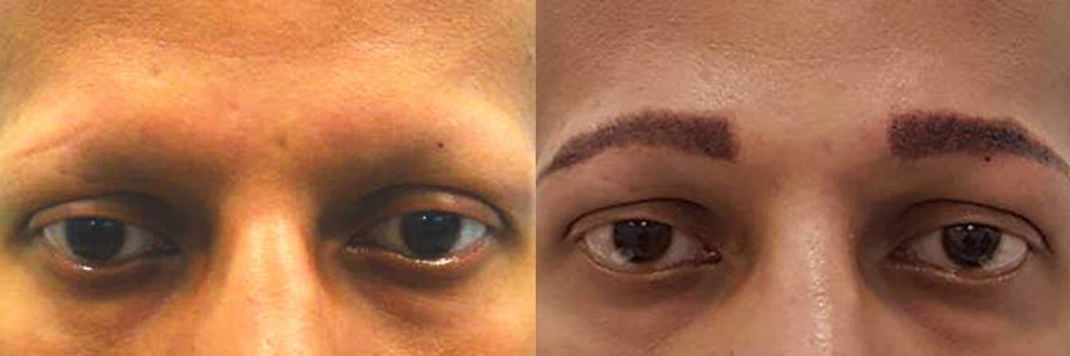 eyebrow transplant cost india