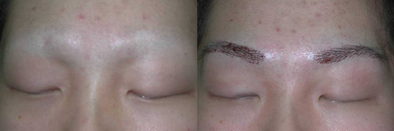 DHI Hair Transplant