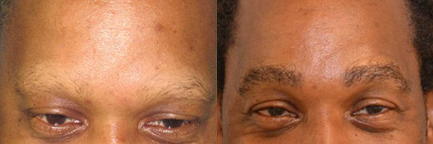 DHI Hair Transplant