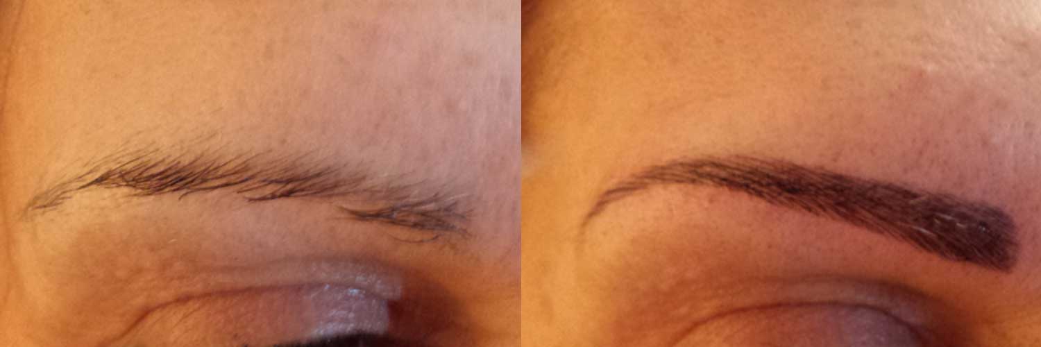 eyebrow transplant cost