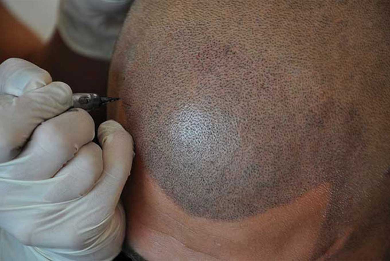 scalp micro pigmentation by DHI International