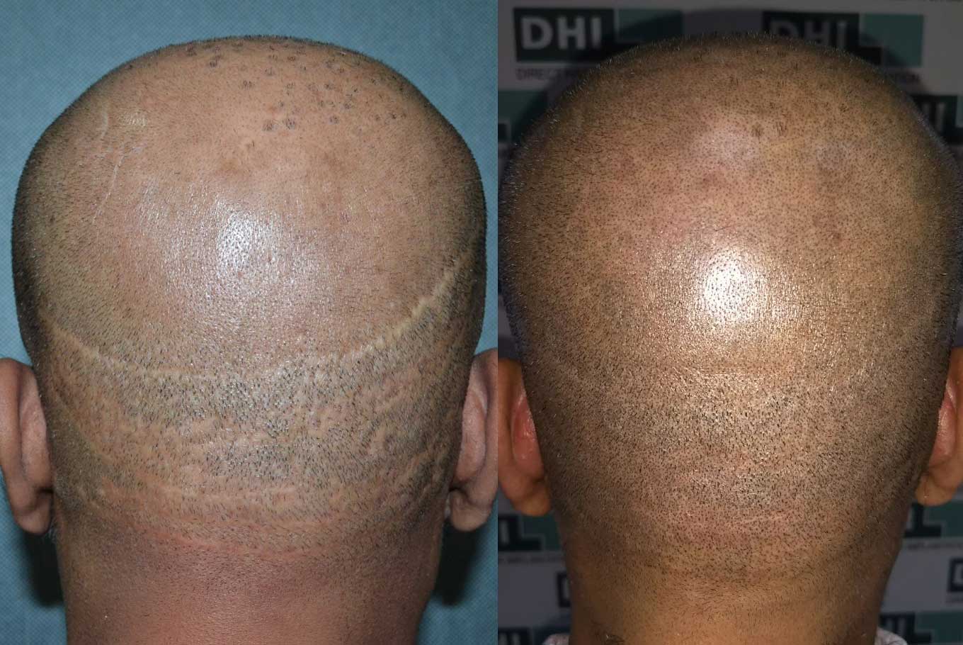 Scalp Micropigmentation SMP  Hair Pigmentation  Heva Clinic