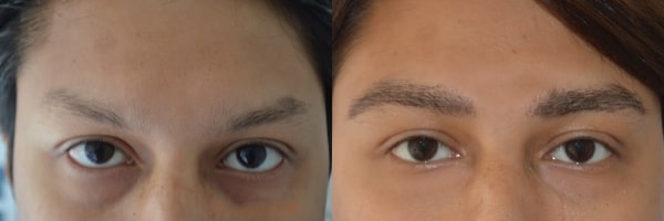 eyebrow transplant cost in india