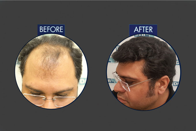 DHI Hair Transplant