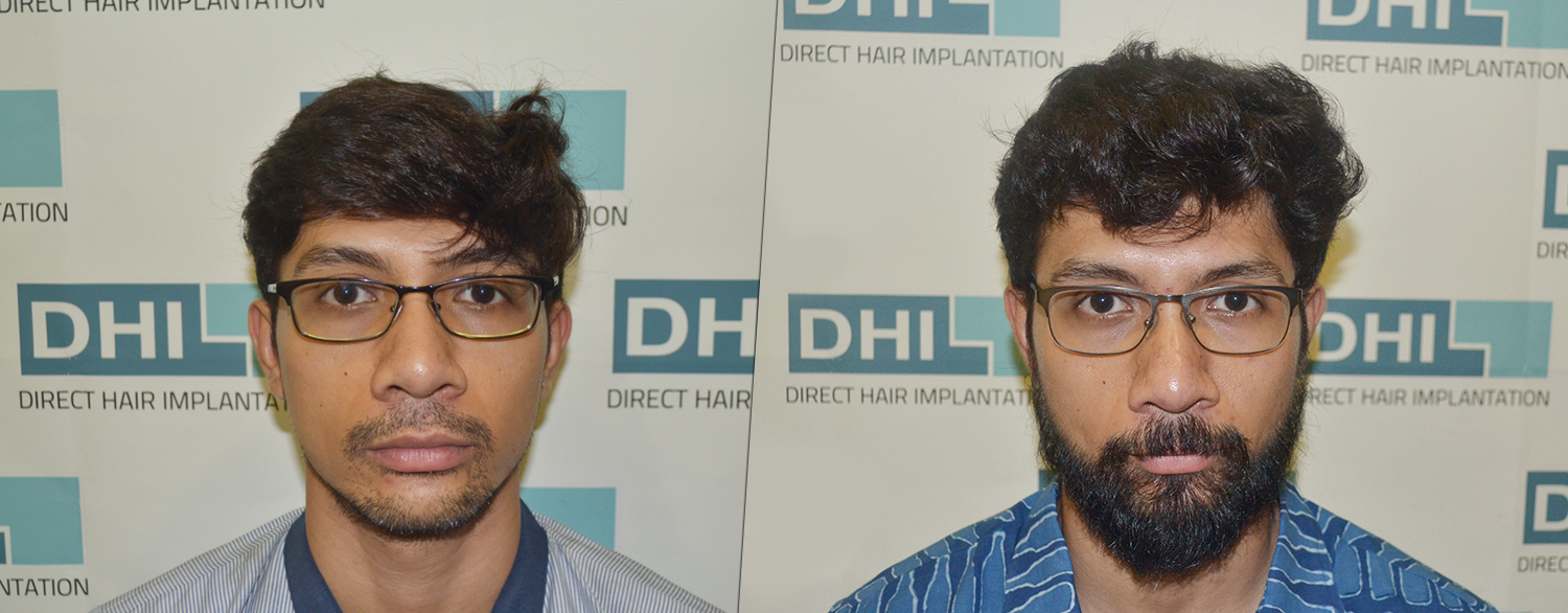 Natural Beard Growth with Beard Transplant