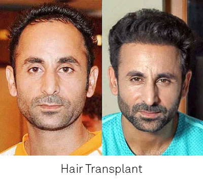 male hair transplant in india