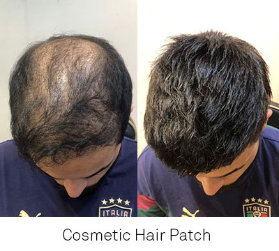 cosmetic hair patch in india