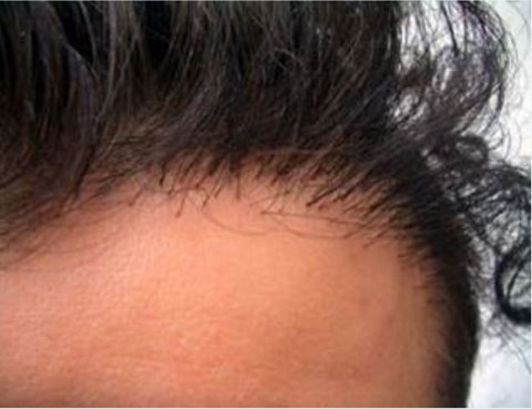 Result after FUE surgery