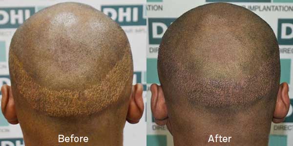 hair transplant scar removal