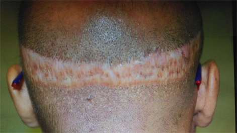 hair transplant scar