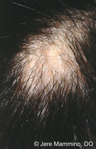 Scarring Alopecia