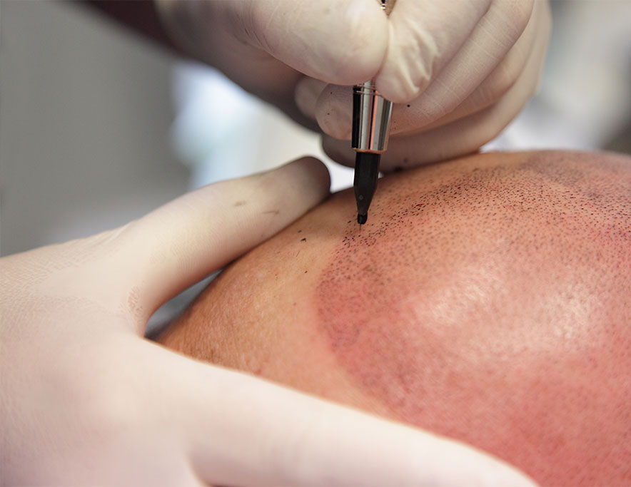 scalp micropigmentation