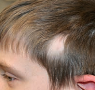 triangular-alopecia
