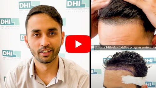 Male Hair Transplant Testimonial