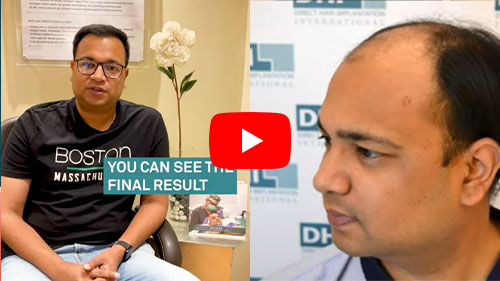 Hair Transplant Testimonial